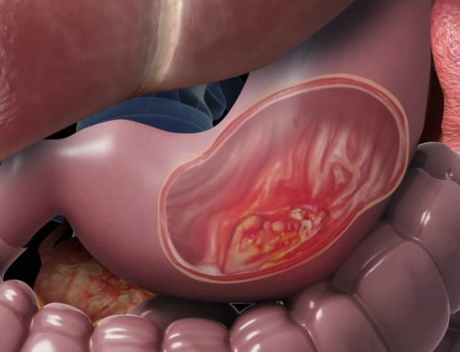 سرطان معده (گاستریک) و تشخیص دقیق آن